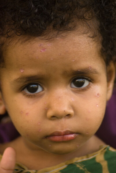 This little girl's solemn expression never changed.
I suspect that her recent case of chicken pox really
took the wind out of her sails. I know I've never seen
a more mournful child in all my time in Vanuatu.
